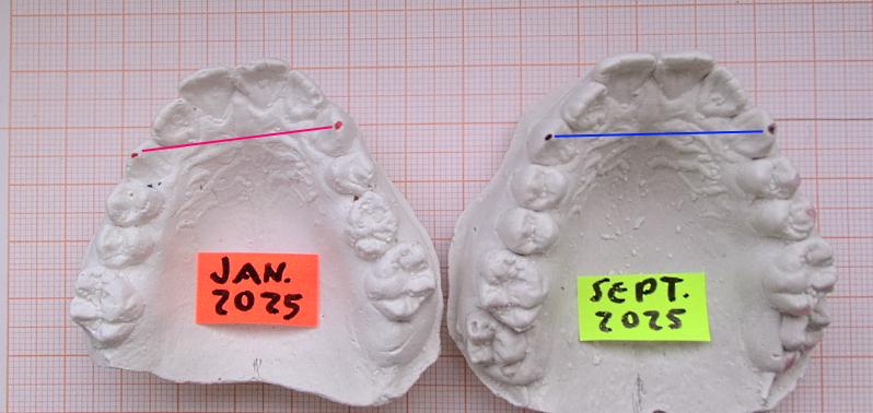 Besondere Fähigkeit vom gut passenden LM-Activator: mehr Symmetrie der Zahnpositionen herstellen